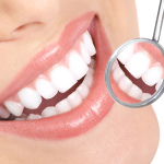 Composites Dental